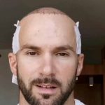 Hair Transplant Timeline for best treatment