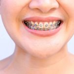 metal braces