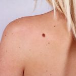 types of moles